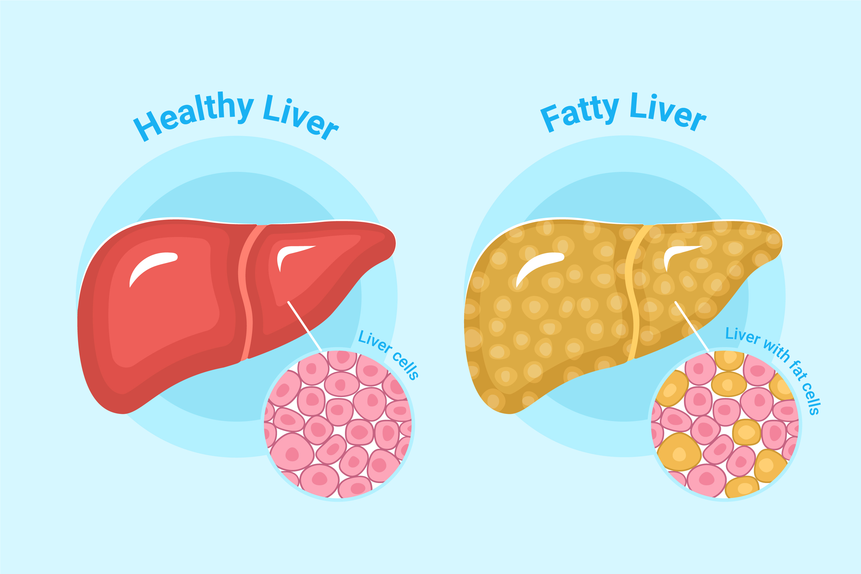 How Ayurvedic Medicine Supports Liver Health and Reduces Fat Accumulation